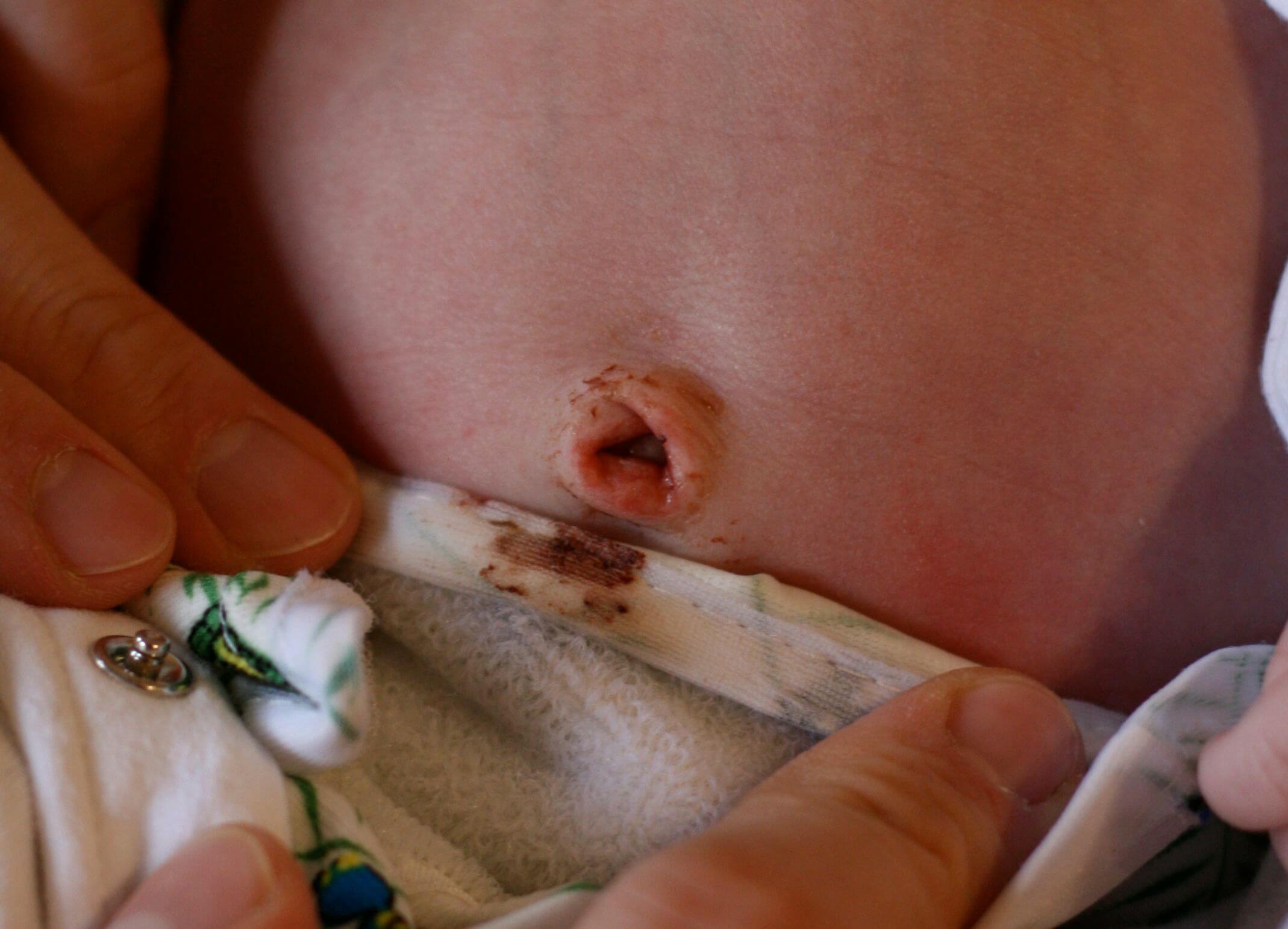 Trẻ sơ sinh bị nhiễm trùng rốn